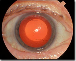 A casa dopo l'intervento: il cristallino-artificiale inseritonell'occhio